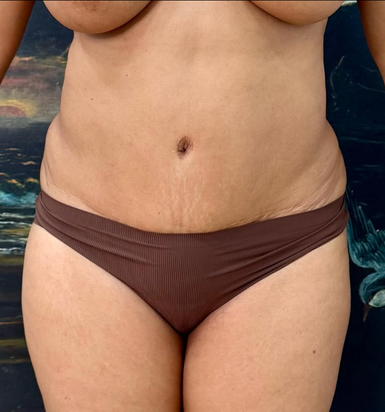Liposuction Before